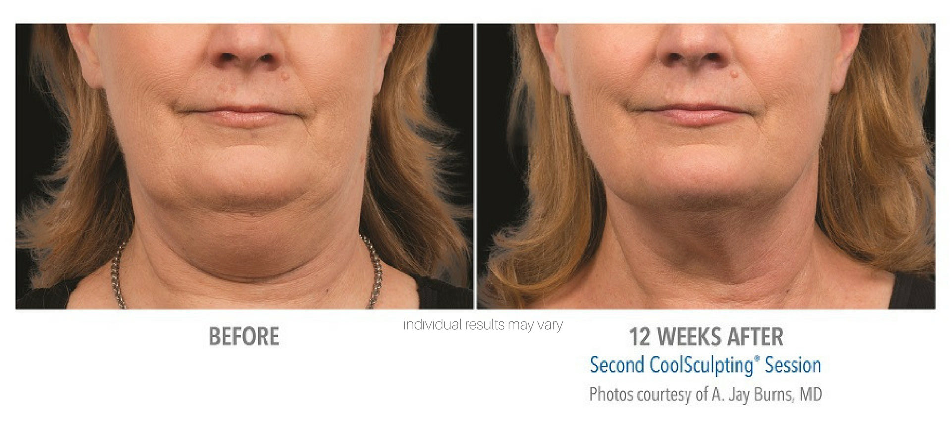 coolsculpting chin reduction on middle aged woman