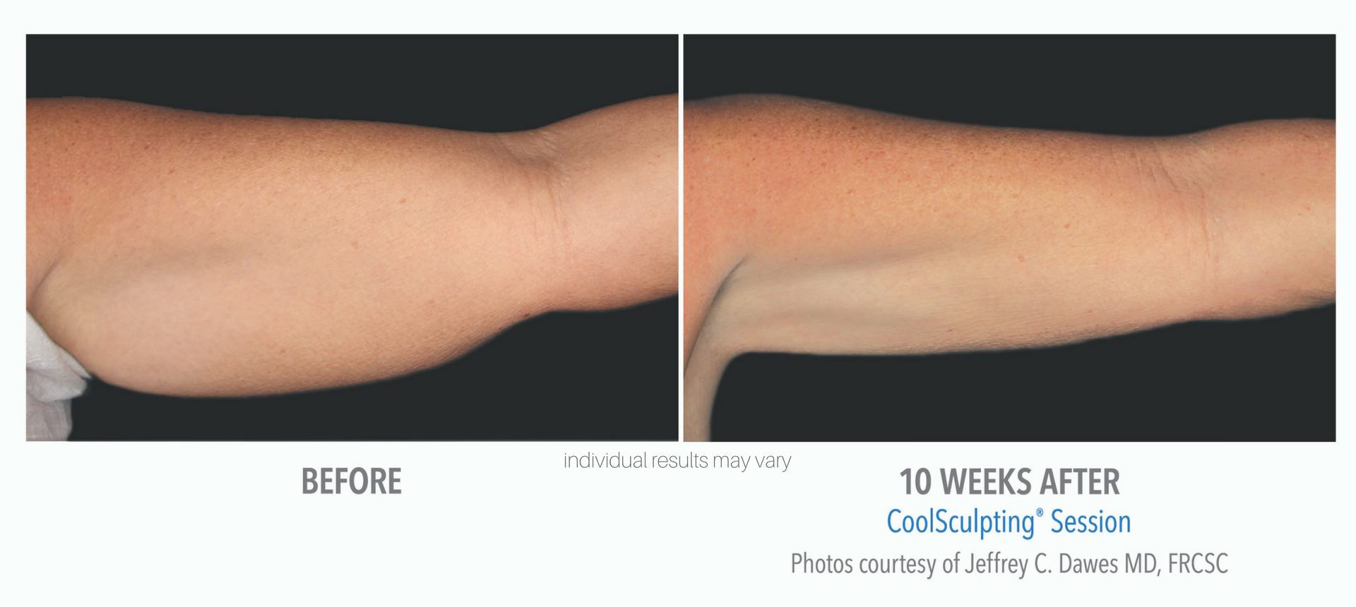 coolsculpting-before-and-after-photos-4