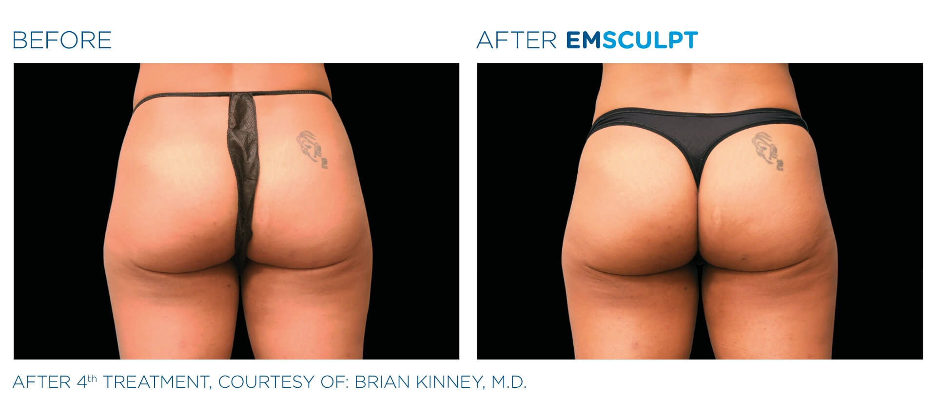 emsculpt-before-and-after-2