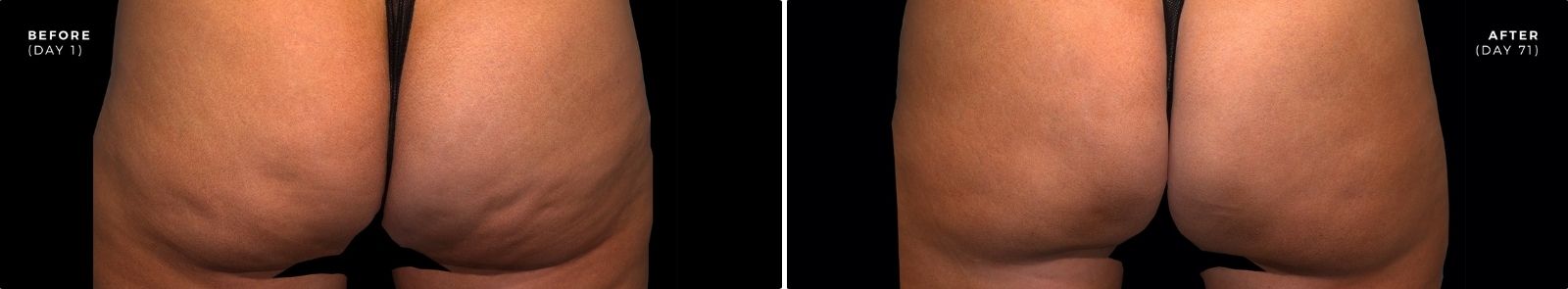 QWO cellulite reduction before and after image at Eternal Medspa