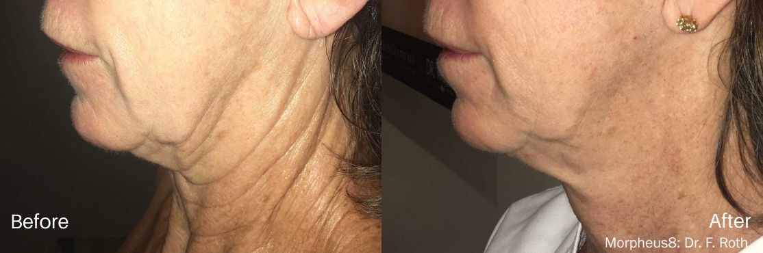 rf-microneedling-morpheus8-before-abd-after-1