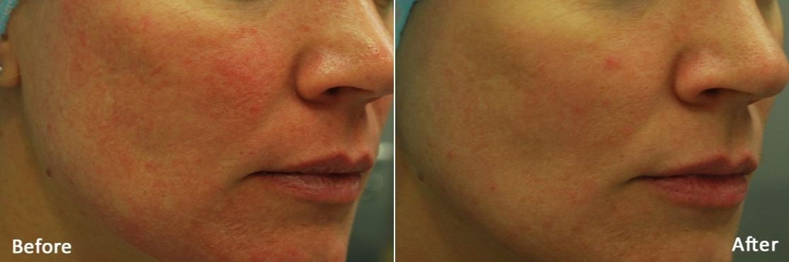 rf-microneedling-morpheus8-before-abd-after-2