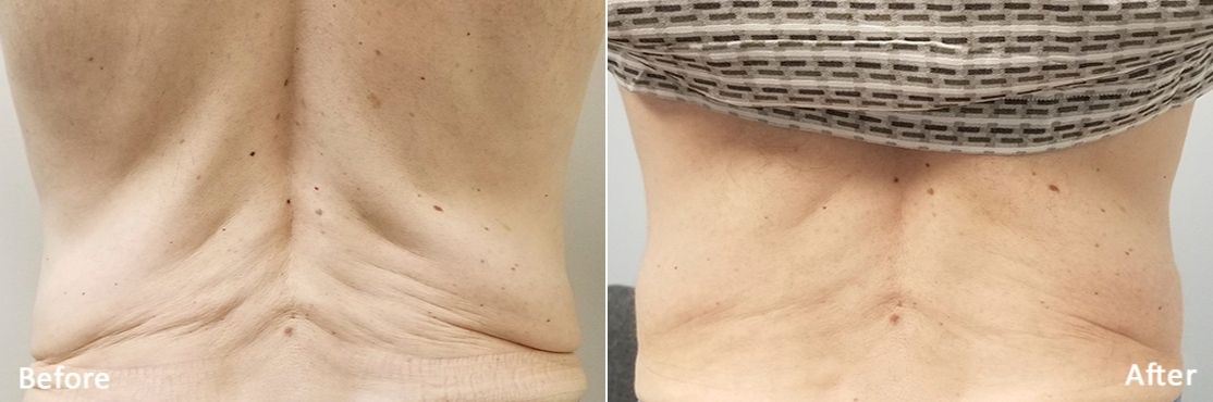 rf-microneedling-morpheus8-before-abd-after-4