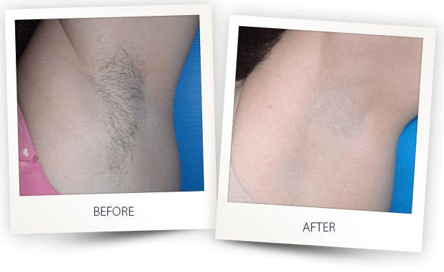 saprano-titanium-laser-hair-removal-before-and-after-eternal-medspa-3