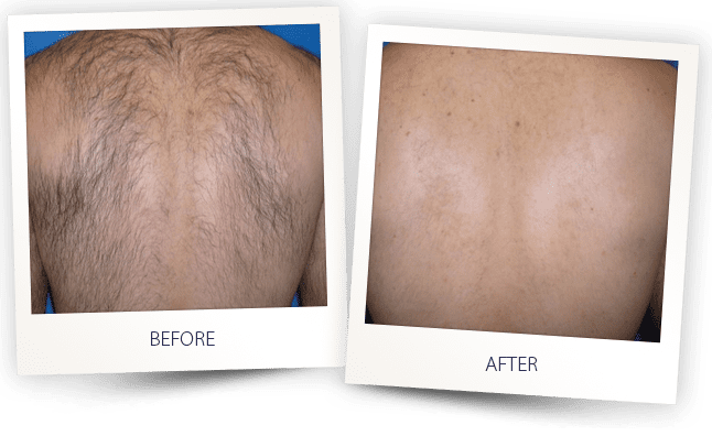 saprano-titanium-laser-hair-removal-before-and-after-eternal-medspa-4