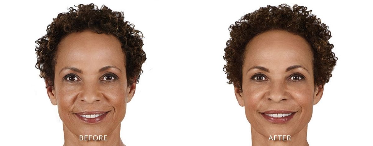 juvederm-before-and-after-image-1