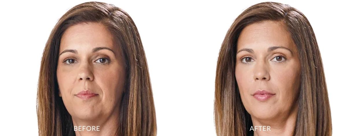 juvederm-before-and-after-image-2