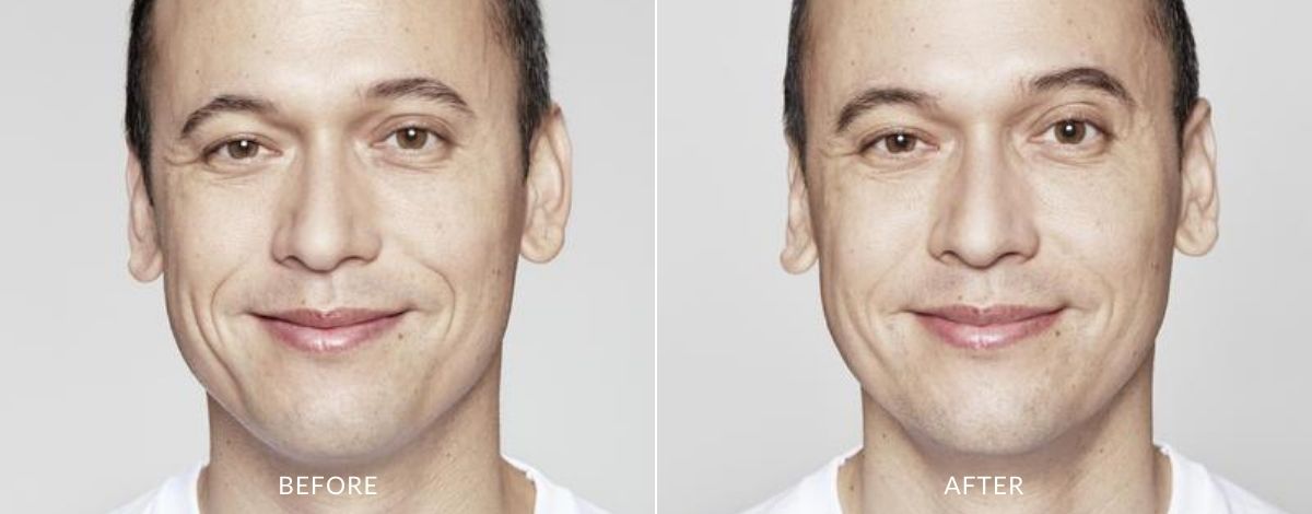 restylane-before-and-after-image-3