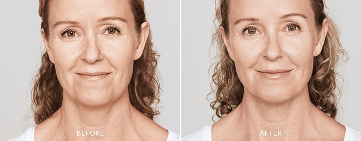 restylane-before-and-after-image-4